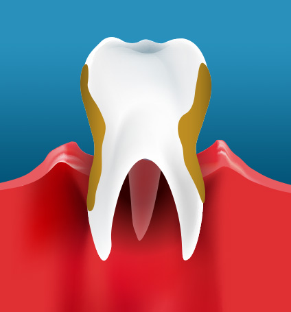 BeautifulSmiles-p_1 Beautiful Smiles of Long Island- Periodontal Disease