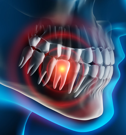 BeautifulSmiles-p_4 Beautiful Smiles of Long Island- Tooth Extraction