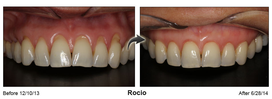 Rocio Beautiful Smiles of Long Island- Pinhole Grafting
