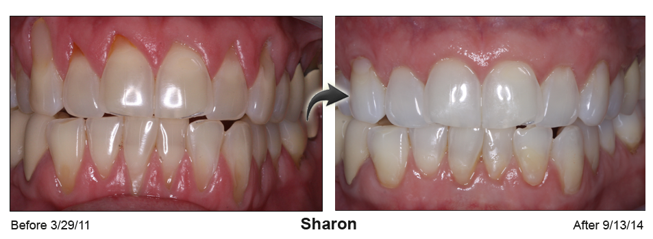 Sharon Beautiful Smiles of Long Island- Pinhole Grafting