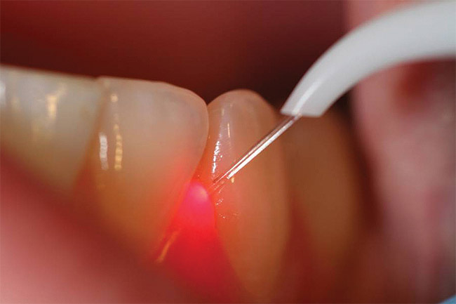 Beautiful Smiles of Long Island- Laser Gum Surgery