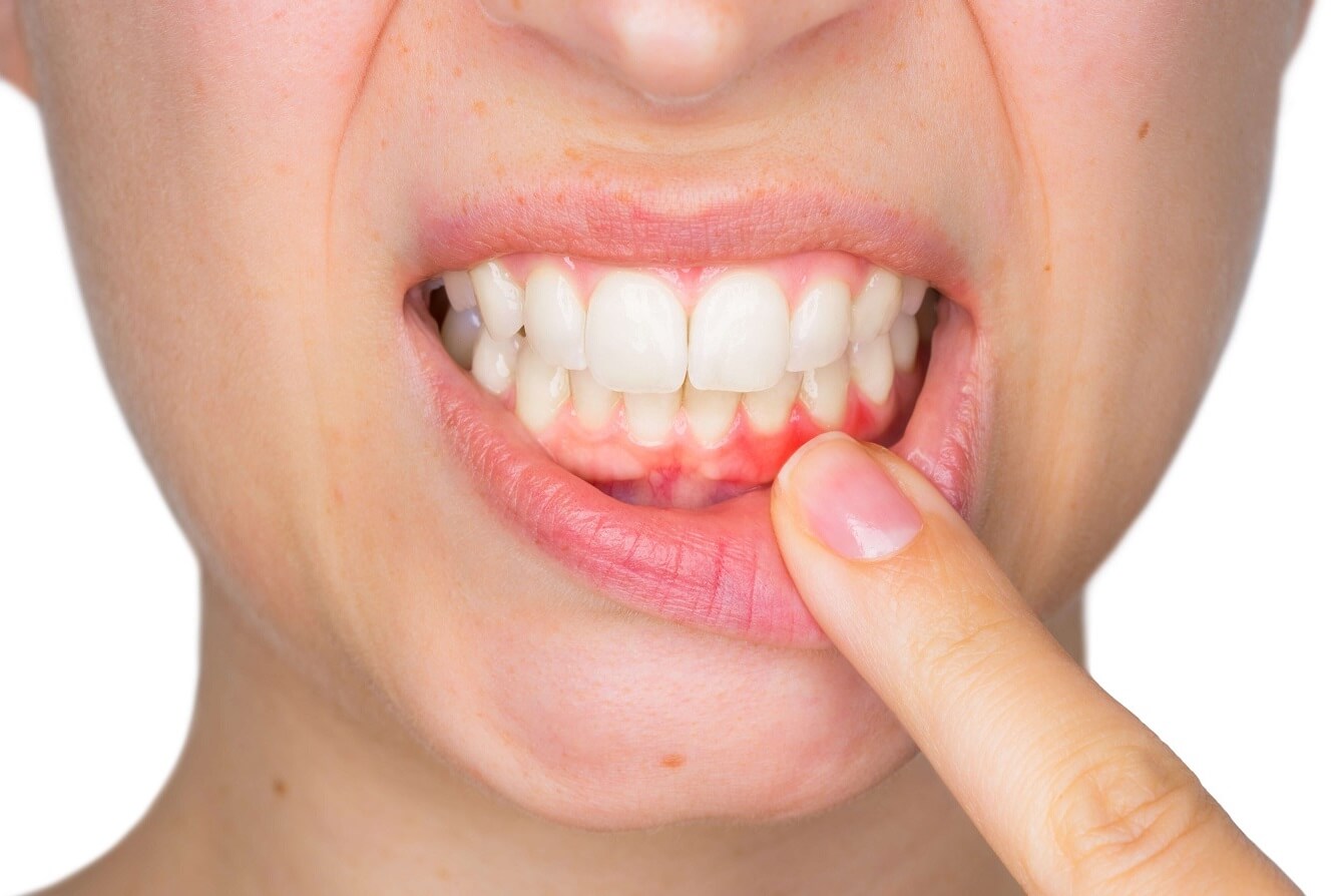 gum disease symptoms