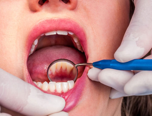 What to Expect of a Dental Cleaning