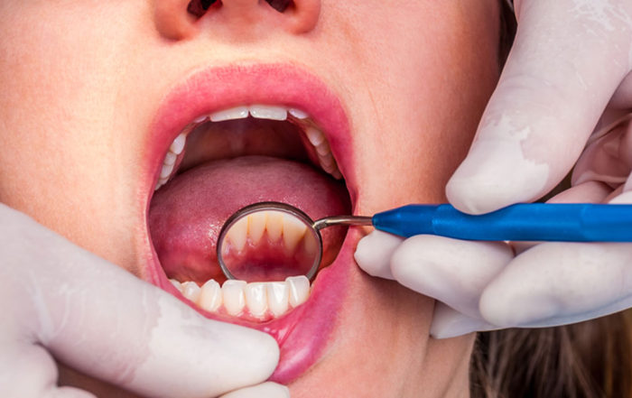 Beautiful Smiles of Long Island- Dental Cleaning