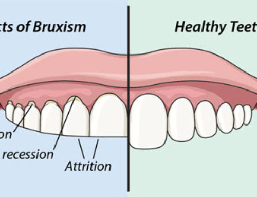 Teeth Grinding